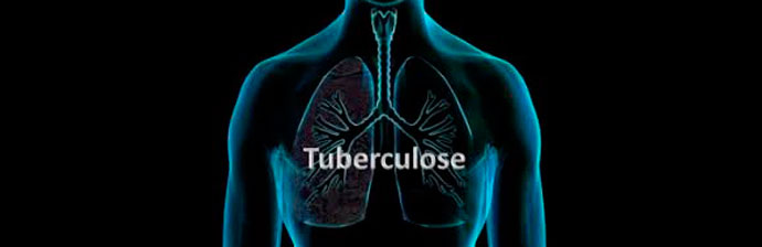 Teste TB LAM melhora o diagnóstico de TB em pessoas com baixas contagens de CD4